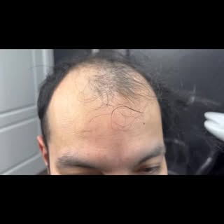 *PAINless
*INSTANT results 
Hair replacement done RIGHT😉
Your transformation is waiting 
To book yo