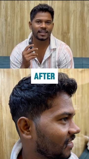 🧔✨ PATIENT REVIEW | 12 DAYS AFTER BEARD TRANSPLANT

Hear directly from our patient as he shares his