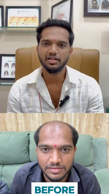 5 months. New growth. New confidence! ✨
Our patient is thrilled with his Hairtronics Pune results an