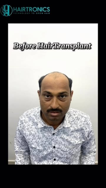 ✨ Another Patient Happy With His Hair Transplant Journey! ✨

We’re pleased to share another patient’
