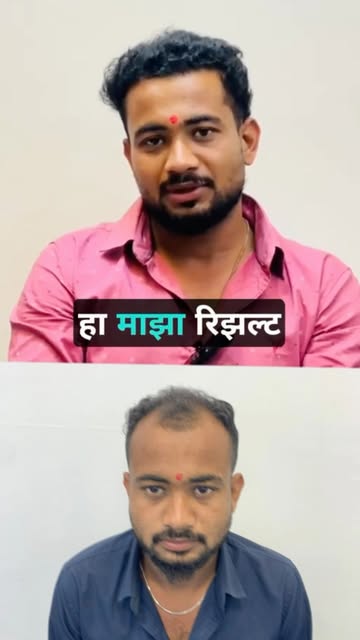 Here’s a cleaner version with a shorter, more readable hashtag set:

🎥 A Patient’s Hair Transplant 