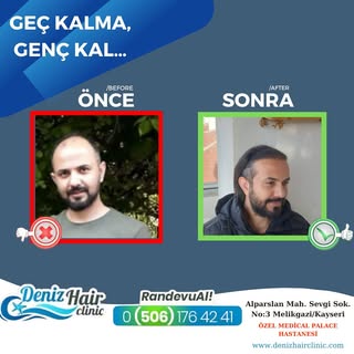 “Geç kalma, Genç Kal ” 🤗
.
.
Kliniğimize başvurarak size uygun uygulamayı doktorumuzla seçebilir