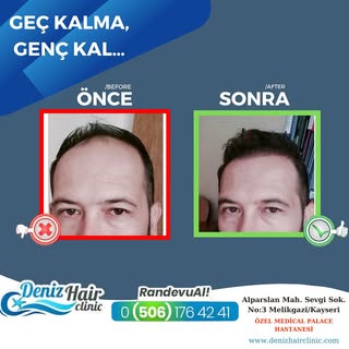 “Geç kalma, Genç Kal ” 🤗
.
.
Kliniğimize başvurarak size uygun uygulamayı doktorumuzla seçebilir
