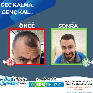 Saçlarınızı baştan çıkarıyoruz…
Sizde saç ekimi yaptırmak istiyorsanız bizimle iletişime geçebilirsi
