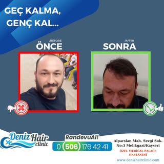 Saçlarınızı baştan çıkarıyoruz…
Sizde saç ekimi yaptırmak istiyorsanız bizimle iletişime geçebilirsi