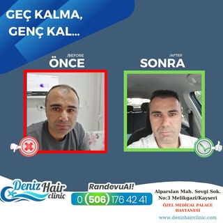 “Geç kalma, Genç Kal ” 🤗
.
.
Kliniğimize başvurarak size uygun uygulamayı doktorumuzla seçebilir