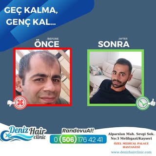 “Geç kalma, Genç Kal ” 🤗
.
.
Kliniğimize başvurarak size uygun uygulamayı doktorumuzla seçebilir