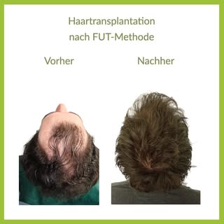 Ein besonders eindrückliches Kundenbeispiel! Dieser junge Mann litt stark an Haarausfall in den Gehe