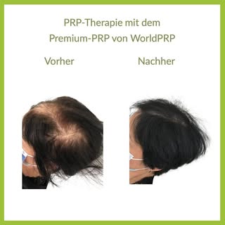 Die 4 - 6x zu wiederholende PRP-Behandlungen führen in den meisten Fällen zu neuem und kräftigerem H