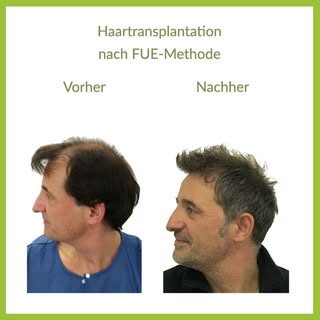 Bei diesem Kunden haben wir mit der beliebten FUE-Methode einzelne Haare am Hinterkopf entnommen und
