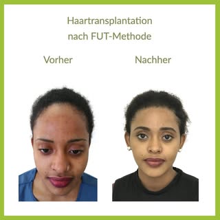 Auch Frauen sind von Haarausfall betroffen! Bei dieser Kundin konnte ein Rückgang der vordersten Haa
