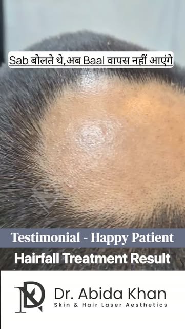 #Testimonial #HappyPatient #HairFallTreatment

• Real People • Real Results • Real Confidence❗️

Hai
