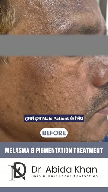 #BeforeAfter

• Real People • Real Results • Real Confidence

Melasma & Pigmentation can be more tha