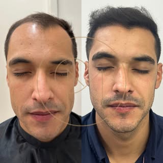 9 meses pós Transplante Capilar FUE e com resultado lindíssimo já! 
Dra. Maria Claudia Macedo  CRM 1