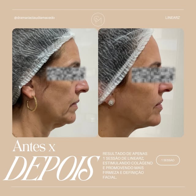 Uma sessão. Um estímulo. Uma nova percepção do contorno facial. ✨

O LINEARZ atua estimulando a prod