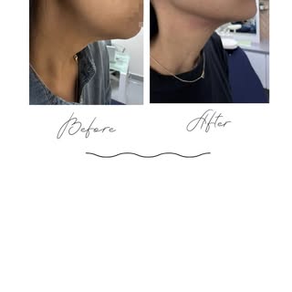 ✨ Bioestimulación de colágeno
Activa la producción natural de colágeno para una piel más firme, lumi