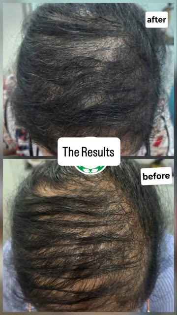 Dermatology is an art and you learn it everyday . #dermatologist #hairtransformation