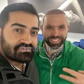 2nd year result of our Italian patient 👑 #hairtransplant #saçekimi #haircityistanbul