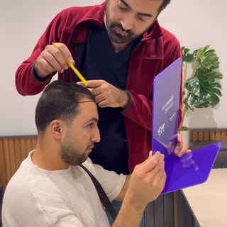 2nd year result of our patient from the Netherlands 🇳🇱 #hairtransplant #sacekimi #haartransplantat
