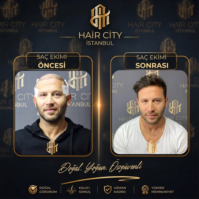 Maksimum Greft Maksimum Yoğunluk Maksimum Doğallık 💎 #saçekimi #saç #hairtransplant
