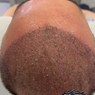 Saç Ekiminden Sonra 10. Günde kabuk döküm işlemi yapılır.Bu videoda hastamızın 10.gün kabuk dökümü s