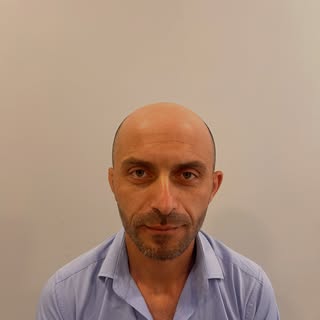 İki seanslık genetik bir saç dökülmesine sahip olan değerli hastamız Murat beyin ilk seans saç ekimi