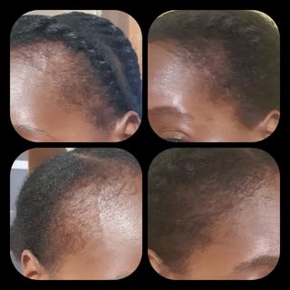 We are so pleased with these amazing results. This patient started having treatments with us in Sept