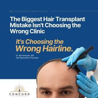 A great hair transplant isn’t just about moving hair—it’s about designing a hairline that looks natu