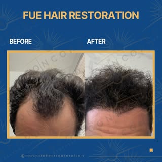 Two areas, one result — crown coverage and hairline restoration in a single FUE procedure.

This is 