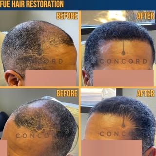 Natural results. Zero linear scars. Quick recovery.
Whether you’re looking to restore your hairline,