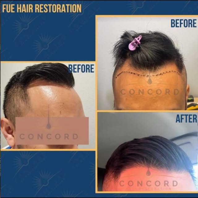 Another impressive result from Concord Hair Restoration. 👏

Our physician-led team takes a personal