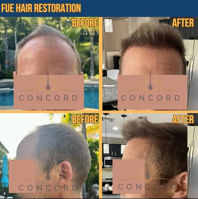 Real, natural-looking results like this are exactly why FUE has become the gold standard in hair res