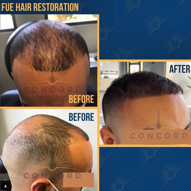 Real results, real transformation. 💪

This patient’s FUE journey shows exactly what’s possible with