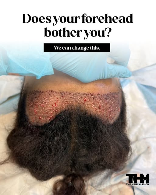 A receding hairline can change more than your appearance—it can affect how you feel about your look.