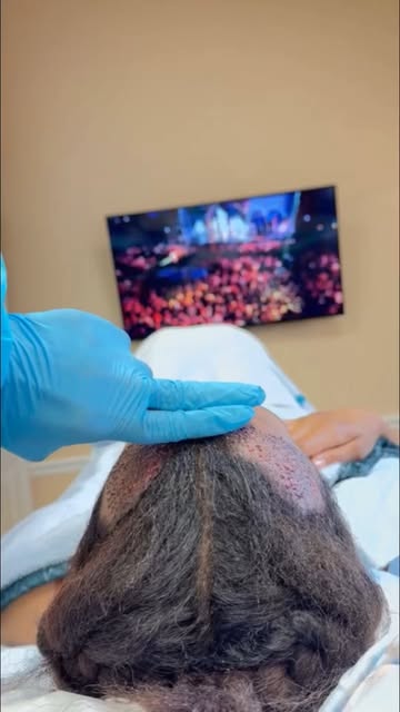 ✨ Traction alopecia can change your hairline — but you don’t have to face it alone.

Traction alopec