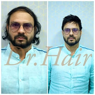 Hair replacement for men 
For details contact us @ 9176545018
www.drhair.in