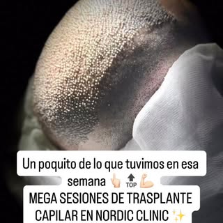 Un pequeño resumen de esa semana en Nordic Clinic Talca. ✨ Mega sesiones de Trasplante Capilar!  #tr