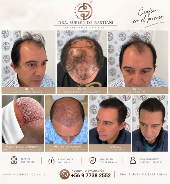 ✨ Confía en el proceso. Confía en el resultado.

Un trasplante capilar es un proceso de evolución. D