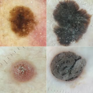 Four distinct patterns, one diagnosis: Seborrheic Keratosis. Courtesy of colleague @carlademarque.de