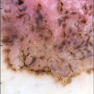 Superficial BCC. Courtesy of colleague @carlademarque.dermato 

#melanoma #skincancer #dermatologia 