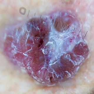Nodular melanoma 

Courtesy of @bedingustavo 

Polymorphous vessels 
White structureless area 
Ulcer