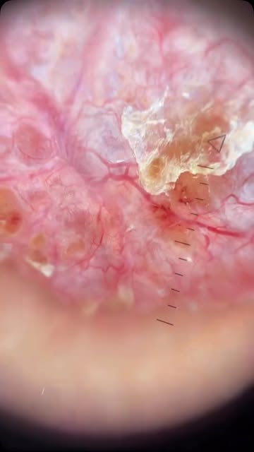 Basal Cell Carcinoma. Courtesy of colleague @andrecapeletti.dermato 

Dermoscopy: arborizing vessels
