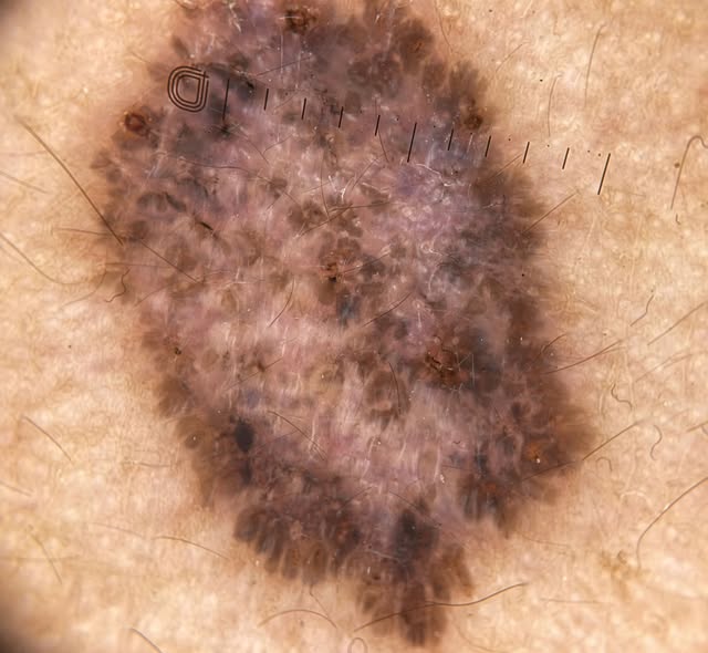 Pigmented Basal Cell Carcinoma. Courtesy of colleague @reem_is_a_penguin 

Dermoscopy: leaf-like str