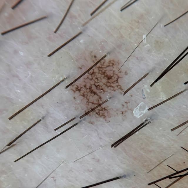Ink spot lentigo. Courtesy of colleague @draadrianabeltrao 

Dermoscopy: black to dark brown reticul