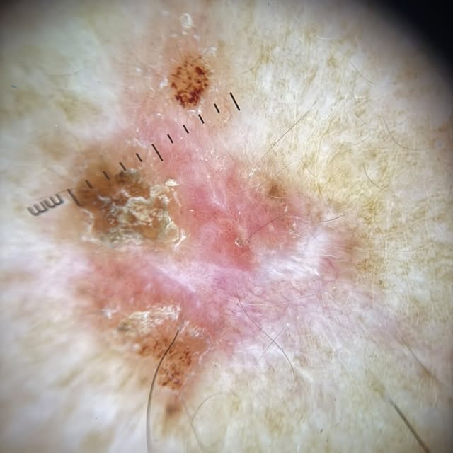 Bowen disease 

Courtesy of @racheldermato 

#dermatology #dermatologia #skin #pele #dermoscopy