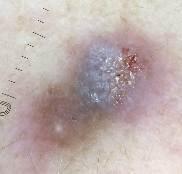 Discoid lupus erythematosus (DLE). Courtesy of colleague @carlademarque.dermato 

Dermoscopy: follic