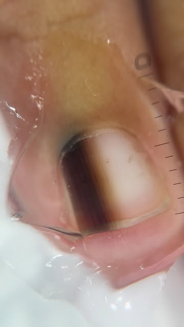 Nail matrix nevi 

Courtesy of @bedingustavo 
🎥 @dermlite DL5 plus 

#dermoscopy #nail #medicine #d