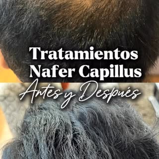 Notas que tu cabello pierde fuerza o tus entradas son cada vez más prominentes? 🛑👇

La alopecia an