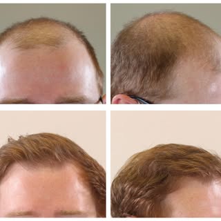 3,500 grafts can make a world of difference, especially in young patients with aggressive and early 
