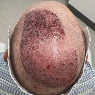 Trust the process. 

What may look unusual immediately post-op will be the solution to this patient’